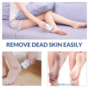 Electric Foot Vacuum Callus Remover - Remove Dead Skin